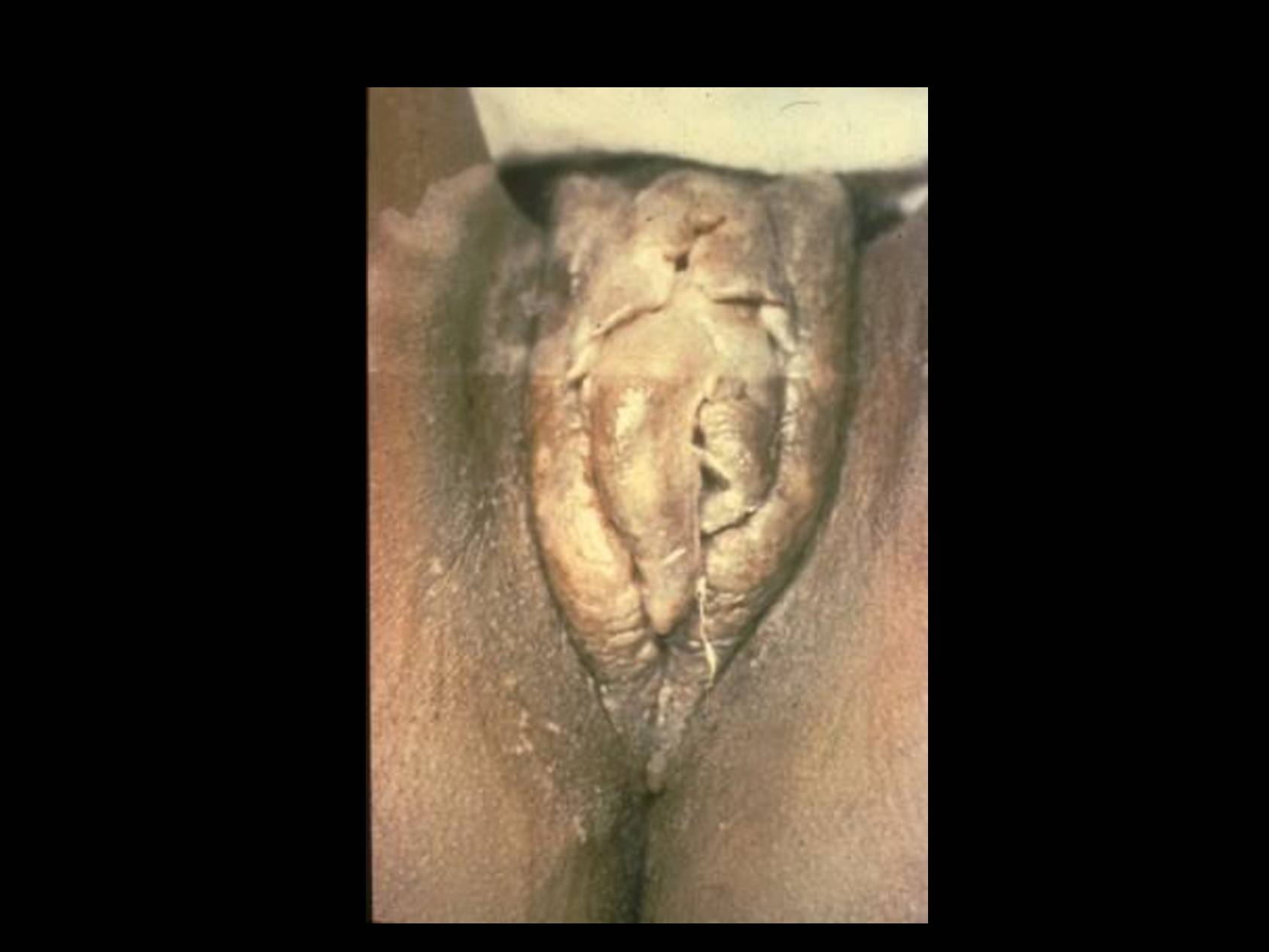 Lymphogranuloma venereum inguinal bubo showing painful swollen lymph nodes in groin with characteristic groove sign caused by Chlamydia trachomatis L1-L3